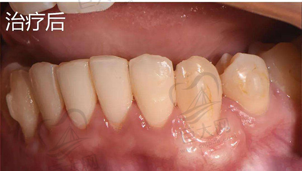 牙龈再生术成效好术后