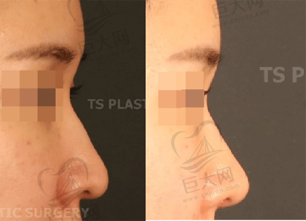 手术前/手术后7天使用耳软骨的无假体鼻部整形