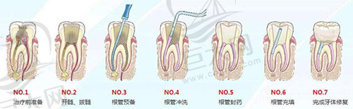 根管治疗