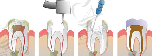根管治疗