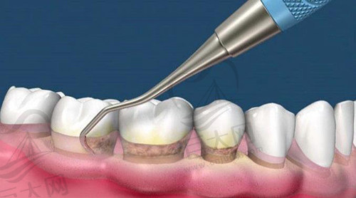 牙周刮治