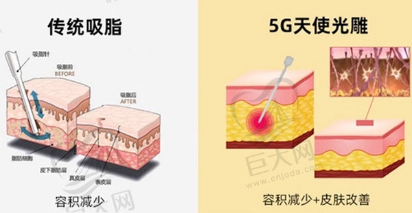 吸脂技术对比.jpg