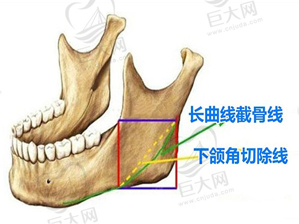 广州罗延平新型下颌角长曲线截骨术优势