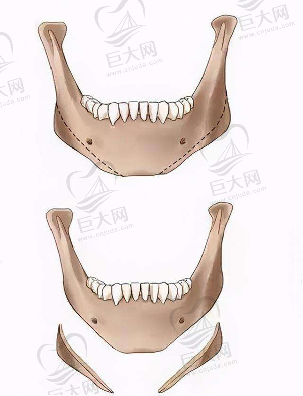 广州罗延平新型下颌角长曲线截骨术优势