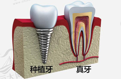 种植牙