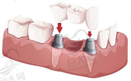 种植牙
