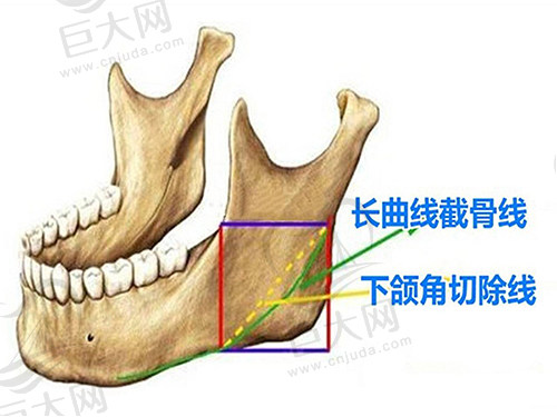 下颌角整形