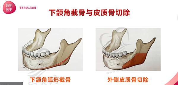 广东韩妃柳超医生磨骨怎么样？做下颌角截骨有失败的吗