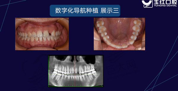 数字化导航种植.jpg