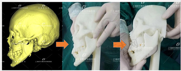 上海时光整形外科医院颌面轮廓手术