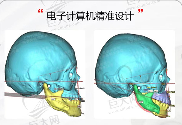上海时光整形外科医院颌面轮廓手术前计算