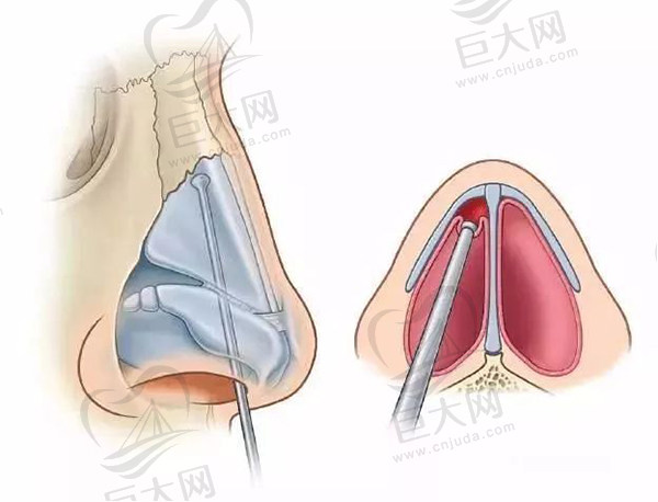 自体鼻中隔软骨隆鼻