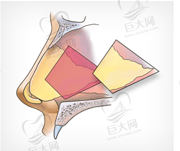 自体鼻中隔软骨隆鼻