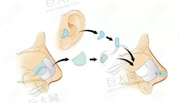 自体耳软骨隆鼻