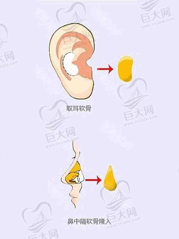 自体耳软骨隆鼻后遗症