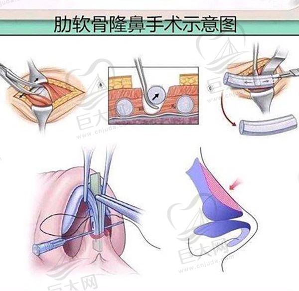 自体肋软骨隆鼻手术