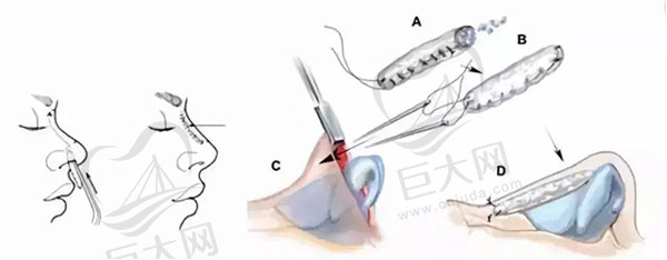 自体肋软骨隆鼻