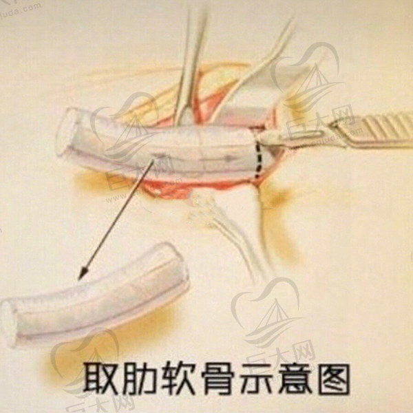 自体肋软骨隆鼻属于几级手术