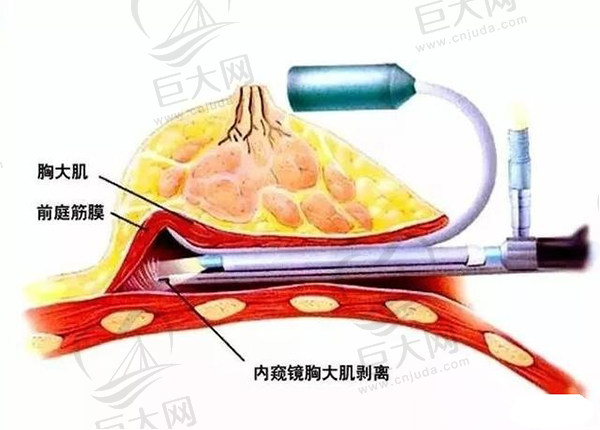 24小时极速丰胸