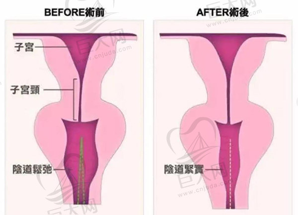 3D生物束带紧缩术能维持几年