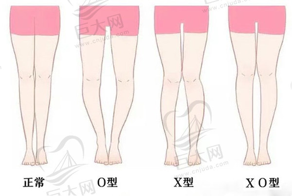 O型腿和X型腿