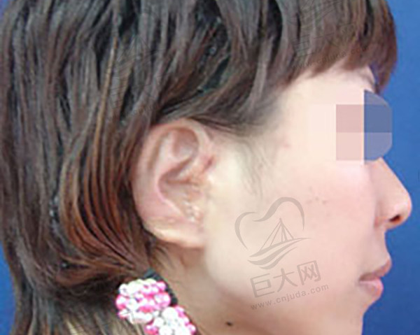 北京八大处整形医院做外耳再造手术