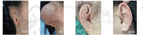 全包耳廓再造术治疗小耳畸形