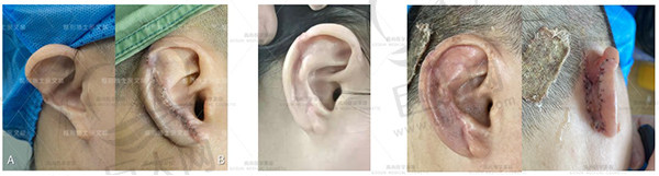 外伤性耳廓缺损的耳再造治疗