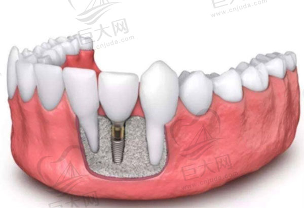 即刻种植牙和传统种植牙的区别在于：植入的位置