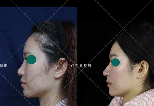 任东高难度鼻修复技术非常惊艳