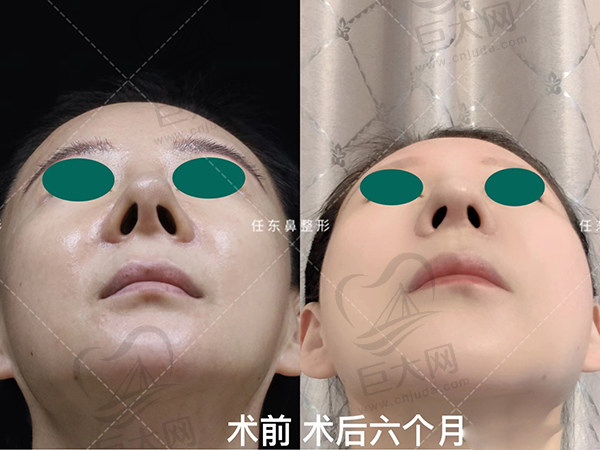 任东高难度鼻修复技术非常惊艳高大鼻改小