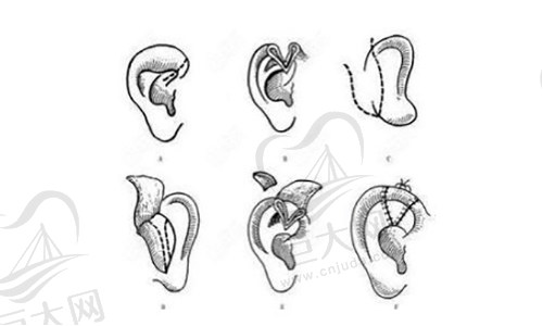 外耳再造