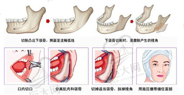 下颌角削骨