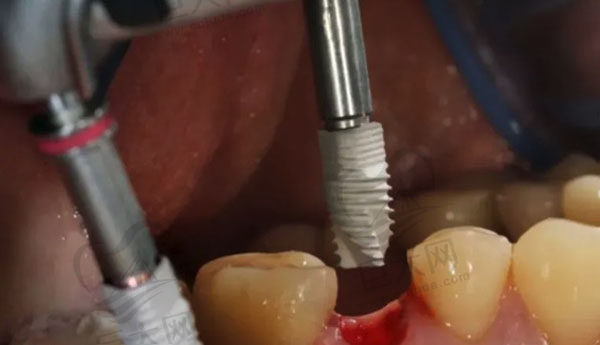请问种植牙一共有几期手术？种植牙的全部过程需要多长时间