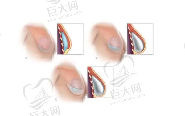 魔滴假体是哪个<span style=