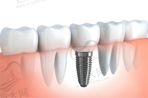 种植牙