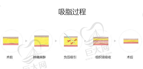 全身抽脂30斤需要多少钱？请问全身吸脂可以一次性完成吗