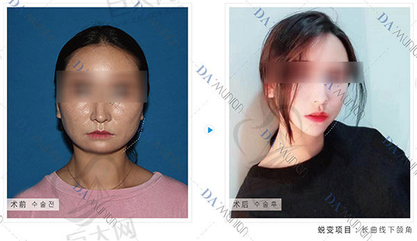 上海美联臣下颌角手术真人图