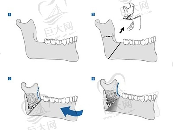 李真秀JSRO双鄂手术