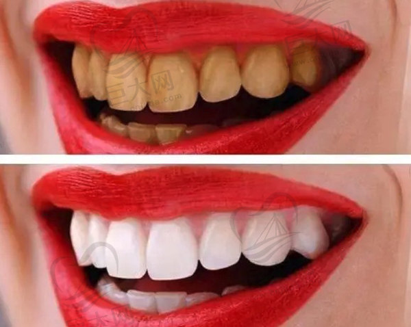 牙齿美白哪种方法好对牙没有伤害？去除黄牙齿变白快来get