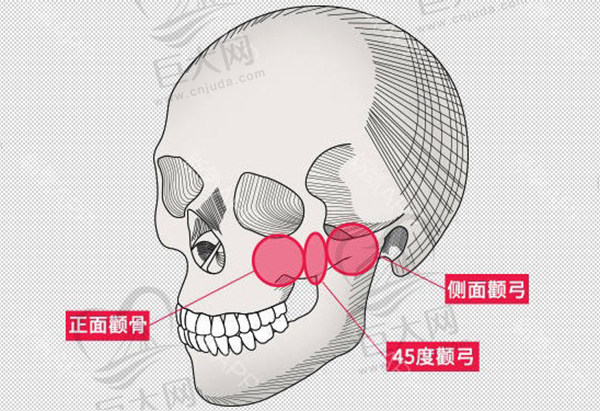 为什么不建议做颧骨内推？因为颧骨内推两年后脸必定下垂吗