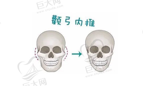 为什么不建议做颧骨内推？因为颧骨内推两年后脸必定下垂吗