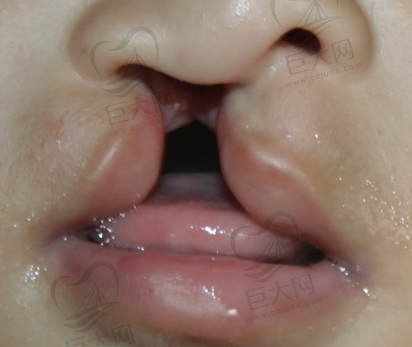 先天性唇腭裂国 家免费治疗吗？或者说国 家对唇腭裂儿童有什么补助