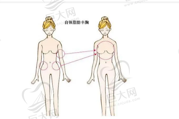 广州自体脂肪隆胸哪家医院好