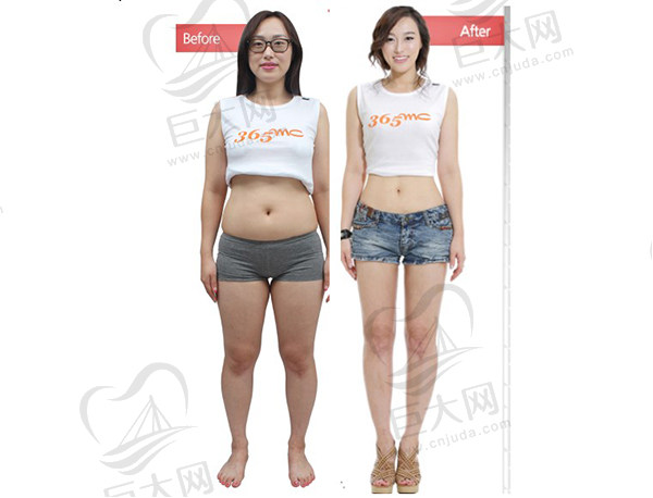 韩国365MCLAMS脂肪管理全身吸脂术前术后对比