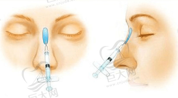面部注射填充隆鼻