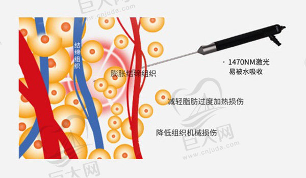 5G天使光雕吸脂刀口大吗