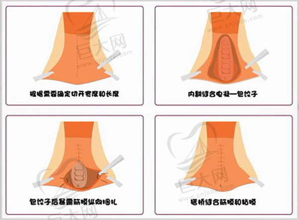 mec壁桥式缩阴手术