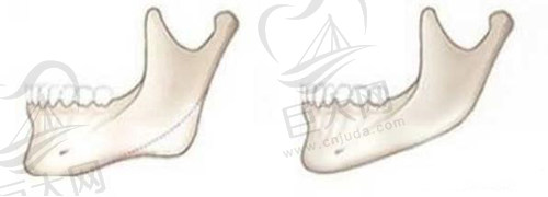 下颌角手术