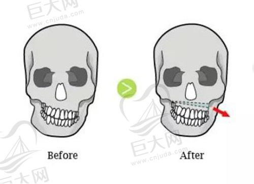 正颌手术 正颌手术